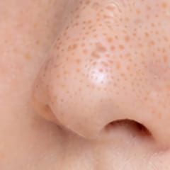 毛穴