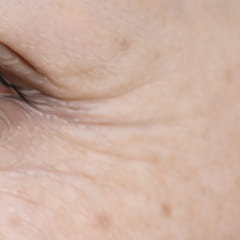 シワ・小じわ