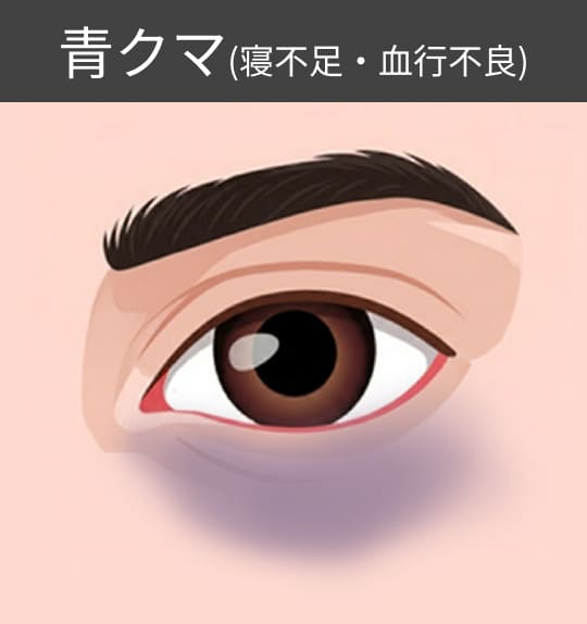 青クマ（寝不足・血行不良）