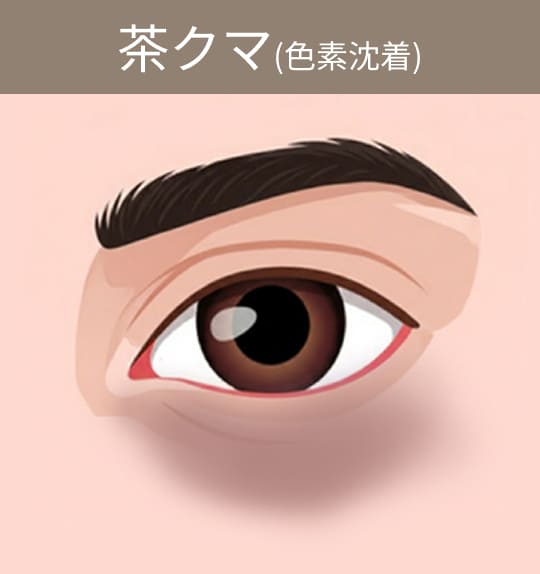 茶クマ(色素沈着)