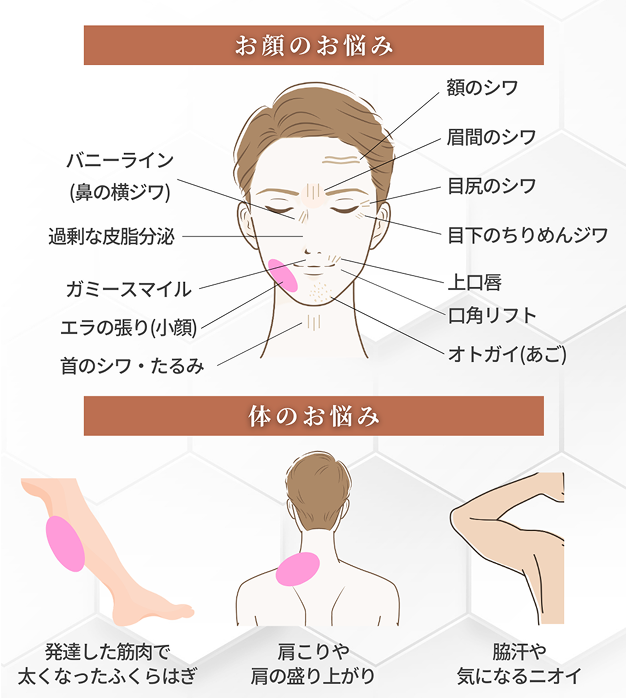 ボトックスとは