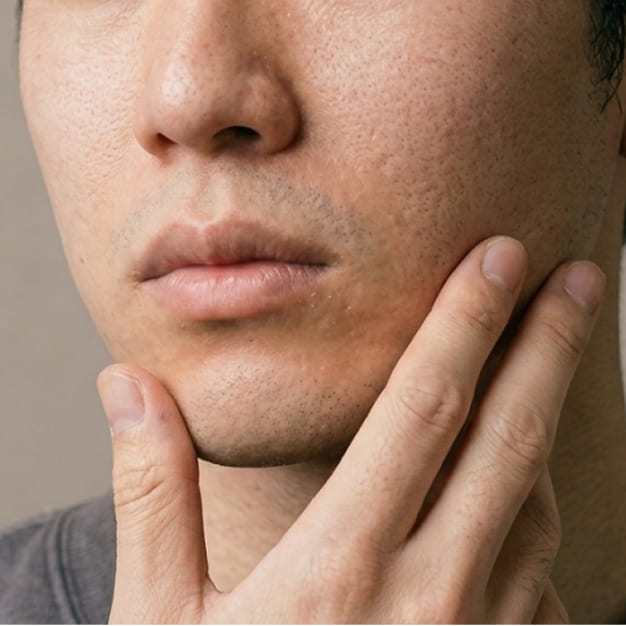 たるみ治療とは