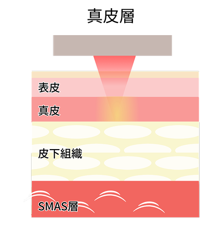 サーマジェン：アプローチ層のイメージ
