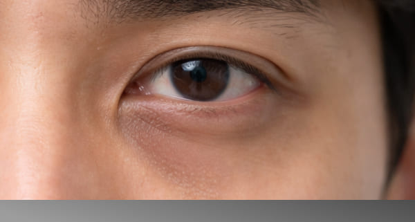 目元・クマのお悩み