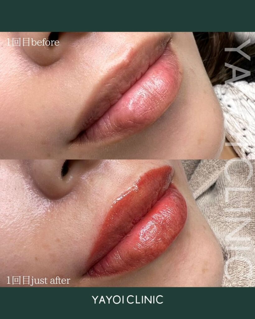 唇アートメイクを広島で受けたい!基礎知識やおすすめクリニックをご紹介