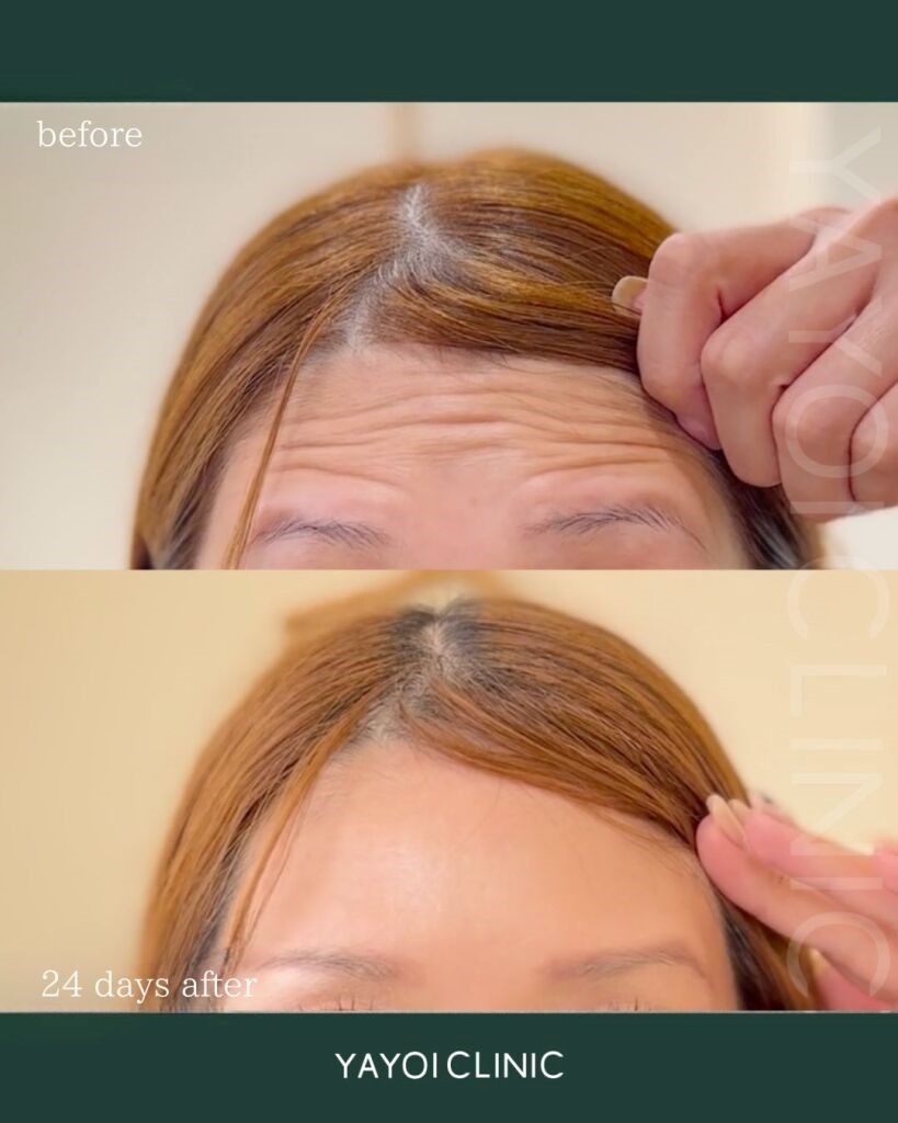 ボトックスで額のシワを解消!施術方法や治療効果、注意点を解説