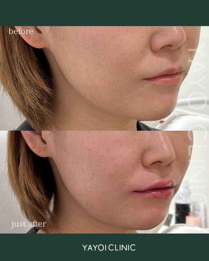 ヒアルロン酸のリップ注入で叶える理想の唇｜初心者も分かる！施術の魅力