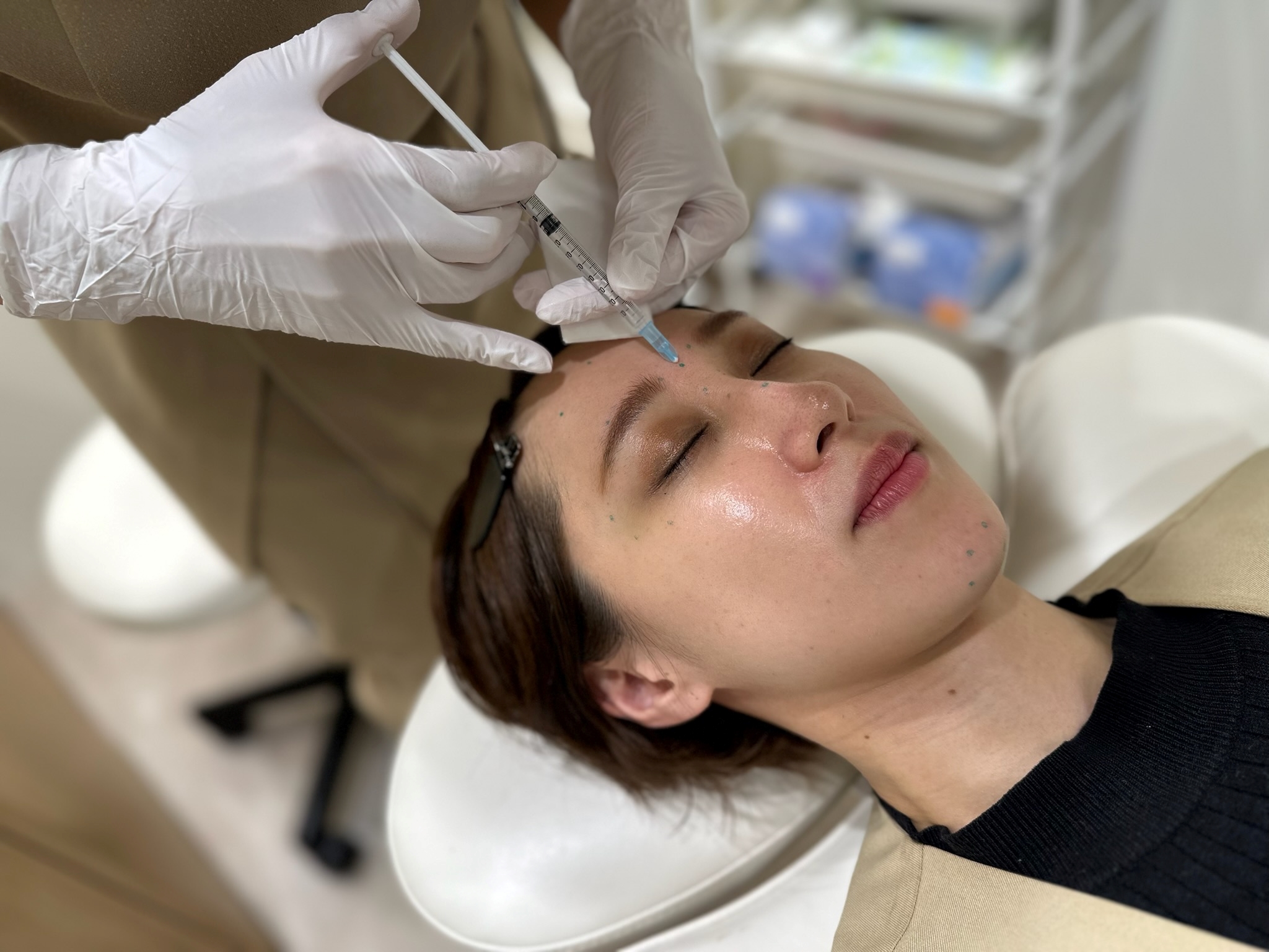 ボトックスは目尻のシワに効果がある?メリット・デメリットを解説