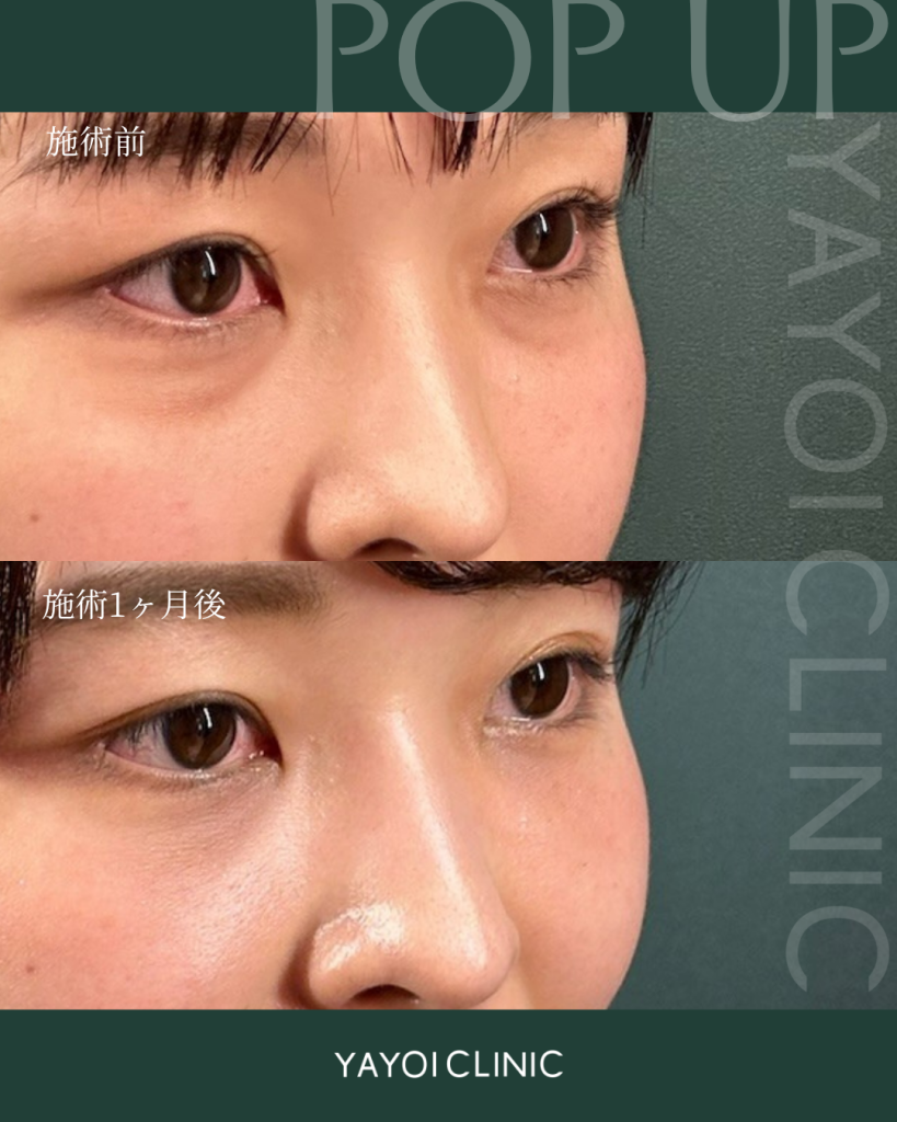 美容外科(脱脂×脂肪注入)