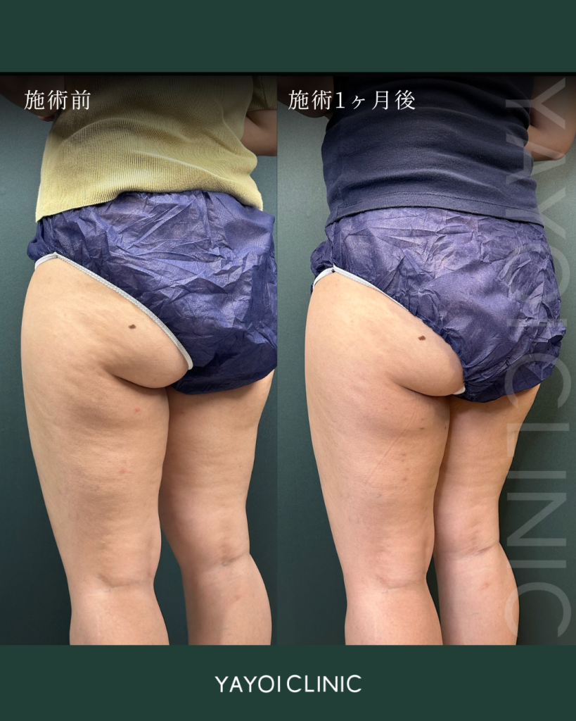 スネコスセル(臀部～大腿)