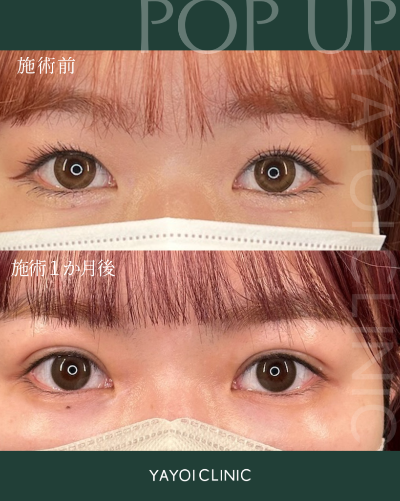 美容外科 二重埋没法(裏留め) B TWICE