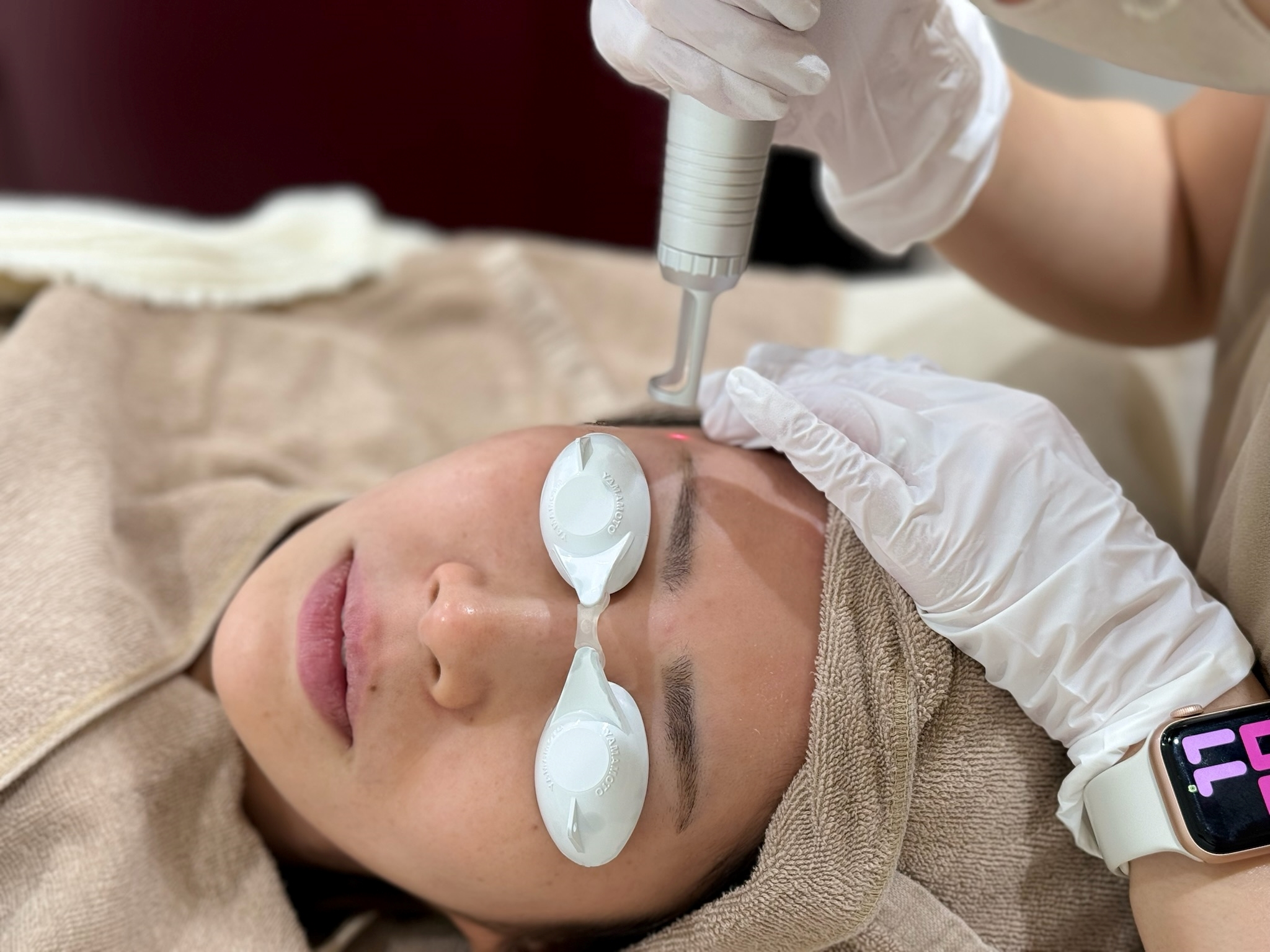 広島でシミ取りレーザーを受けたい!ヤヨイクリニックが治療法を解説