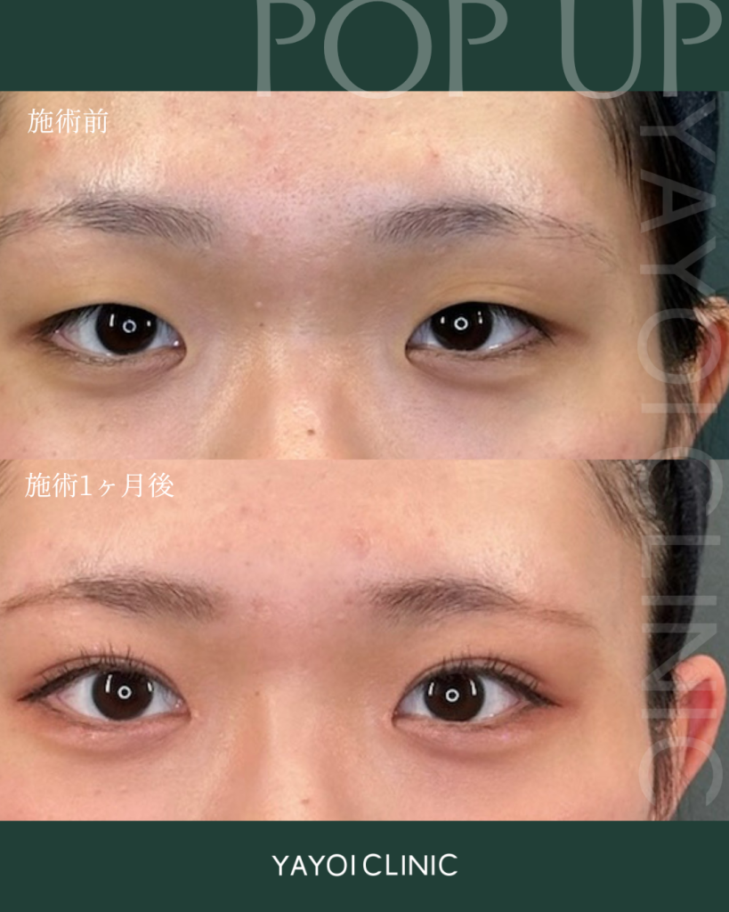 美容外科(B TWICE×目頭切開×鼻ヒアルロン酸)