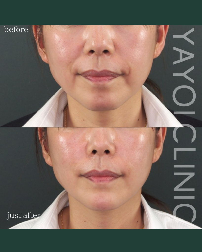 ほうれい線へのヒアルロン酸注入を広島で受けたい！施術の流れや効果を解説