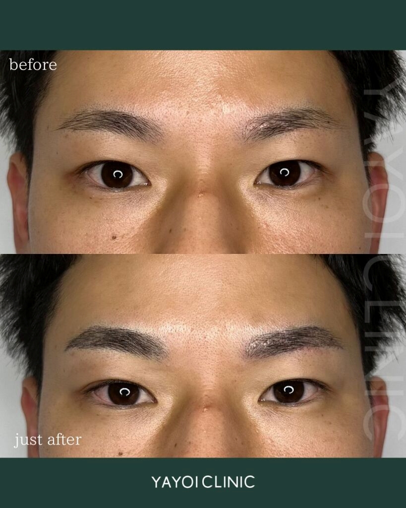 【アートメイク広島】人気メンズ向け施術やクリニック選びのポイントも解説