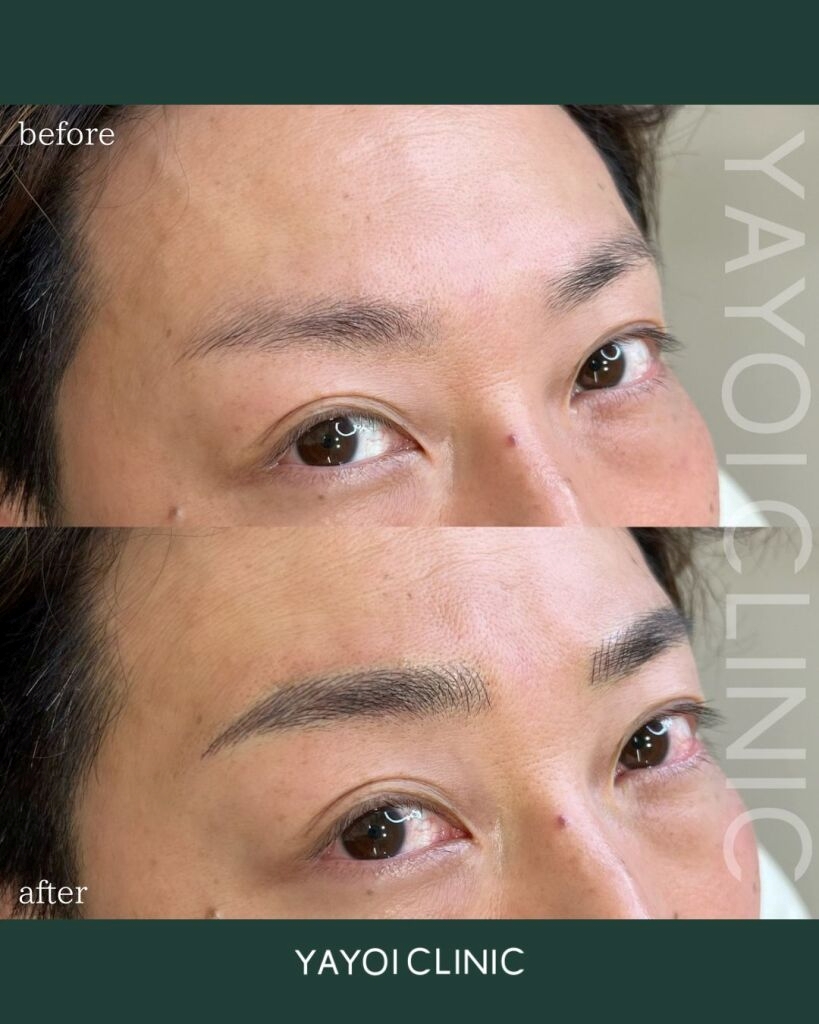 【アートメイク広島】人気メンズ向け施術やクリニック選びのポイントも解説