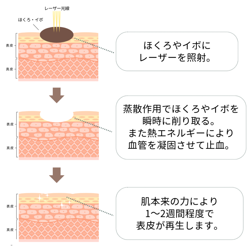 広島でイボを除去したいなら美容皮膚科ヤヨイクリニック!施術の流れを解説