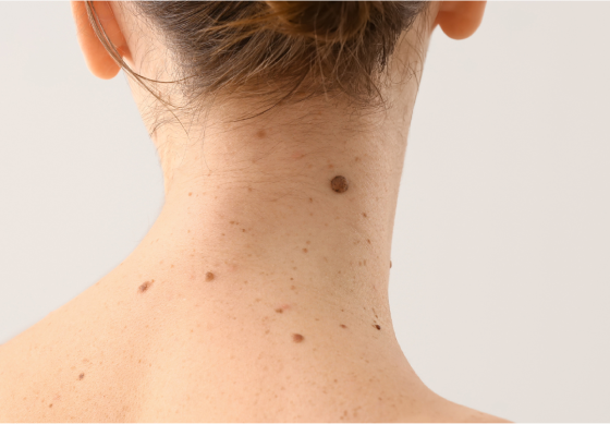 首イボを広島で取ろう！症状や治療方法を解説｜施術前後の注意点も