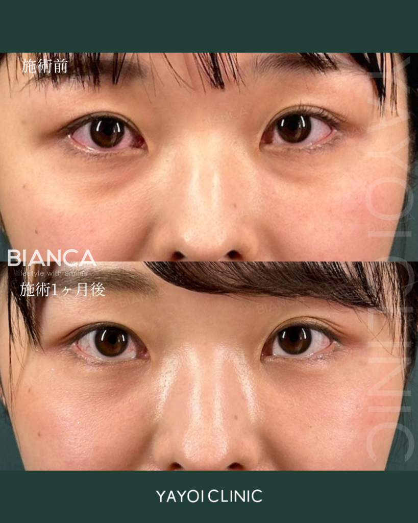 美容外科目の下のクマ・たるみ取り（結膜脱脂術）＋脂肪注入