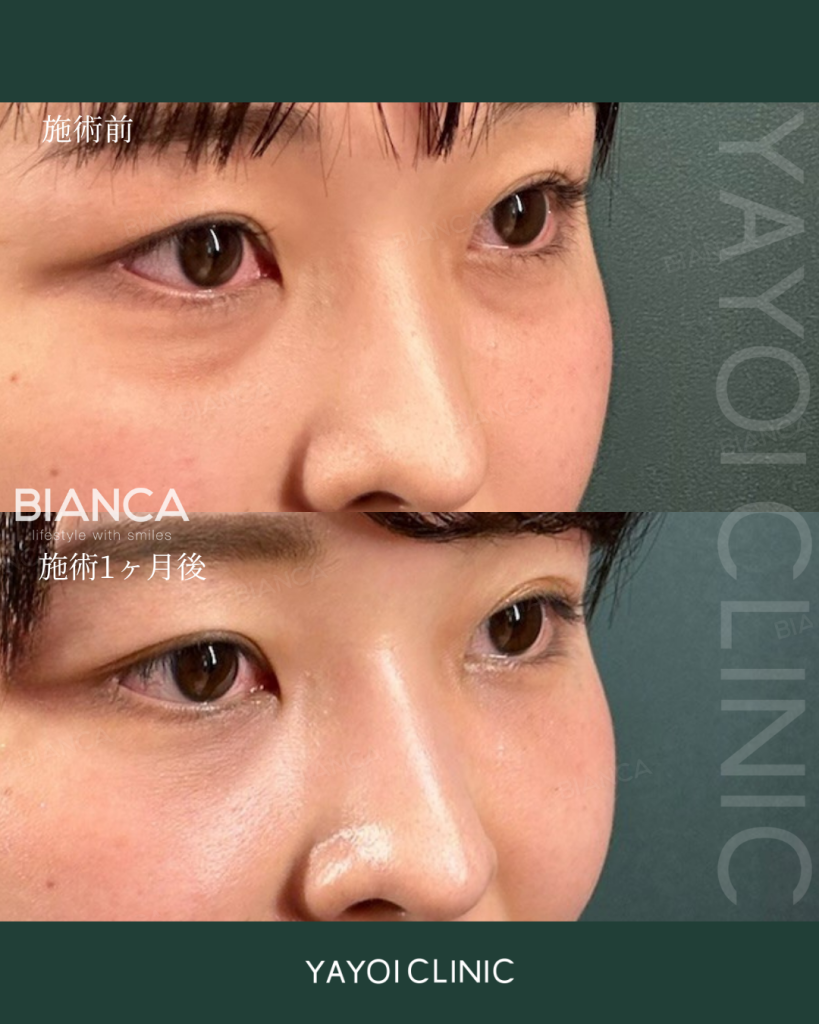 美容外科目の下のクマ・たるみ取り（結膜脱脂術）＋脂肪注入