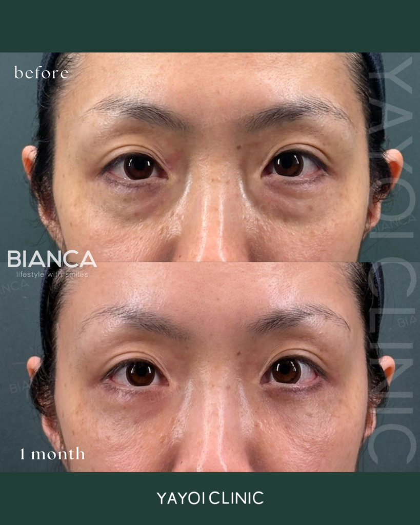 美容外科目の下のクマ・たるみ取り（結膜脱脂術）＋脂肪注入