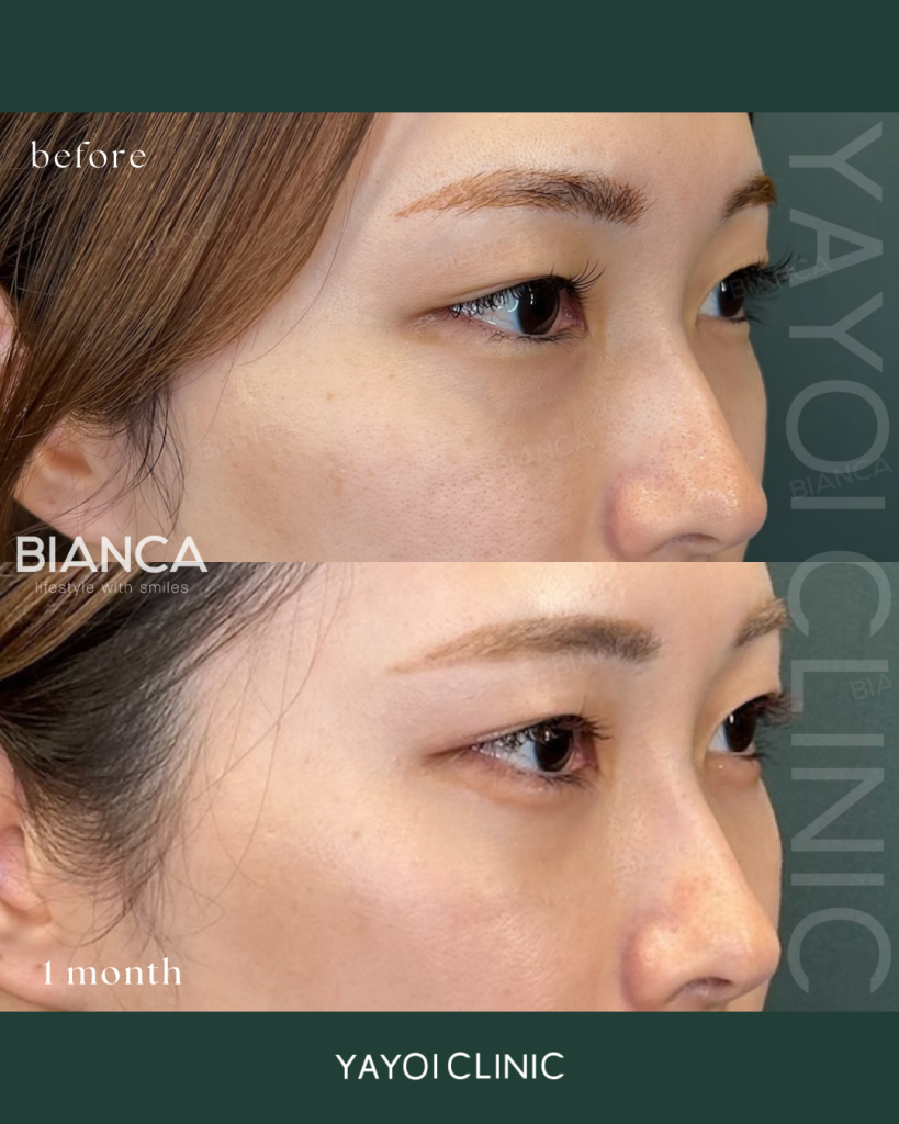 美容外科目の下のクマ・たるみ取り（結膜脱脂術）