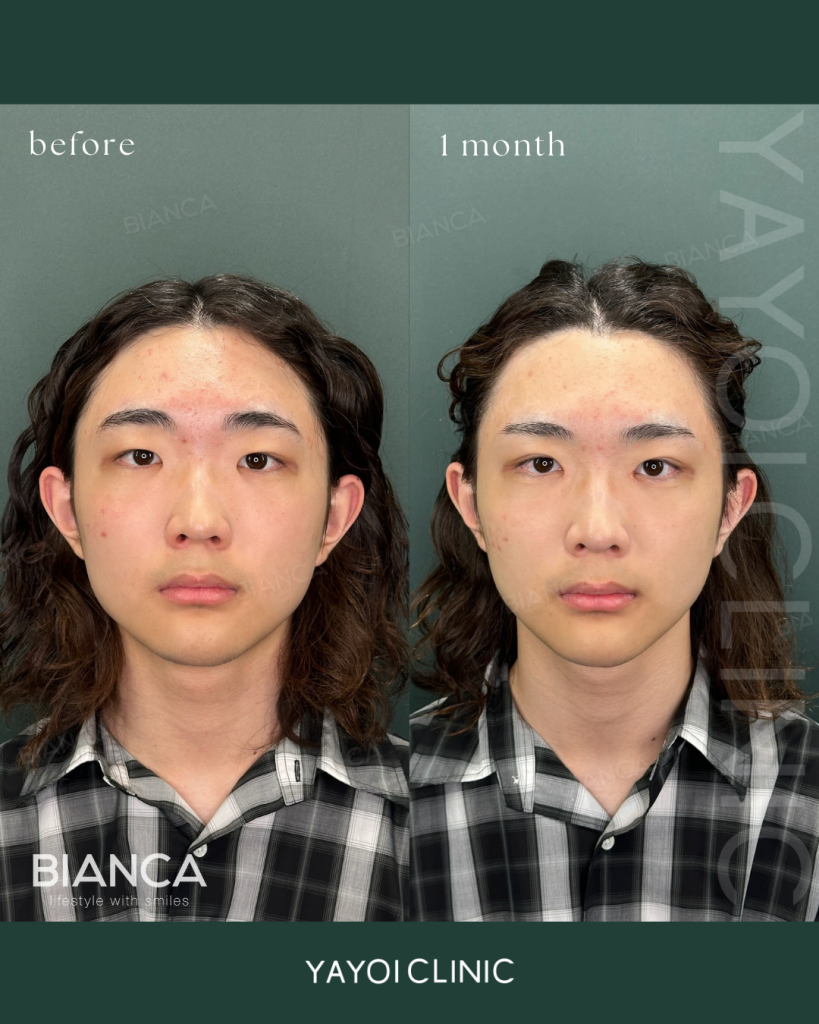 美容外科(B TWICE×目頭切開×鼻ヒアルロン酸)➁