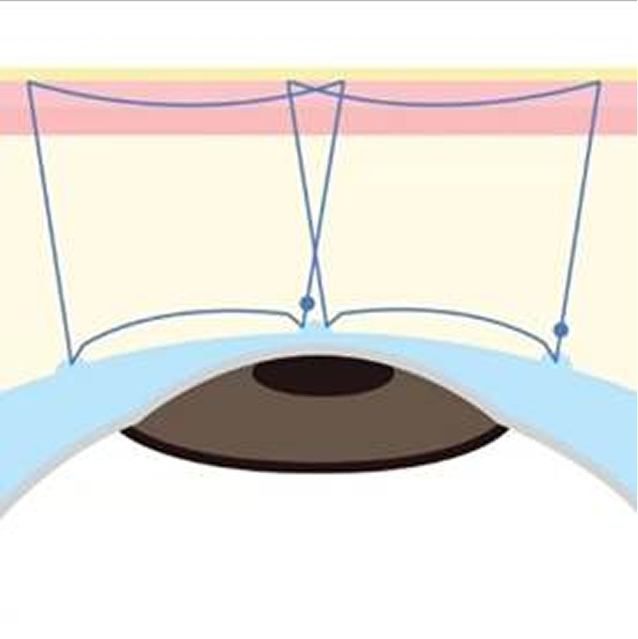 二重埋没法(裏留め)B TWICE