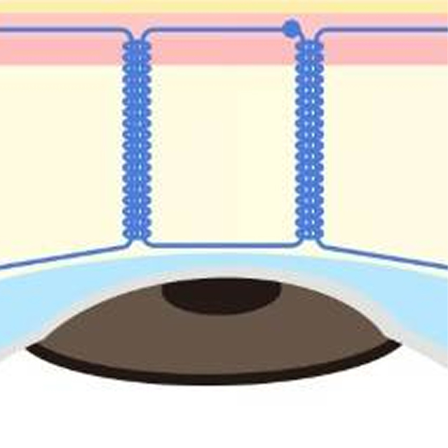 二重埋没法 クロスリンク法