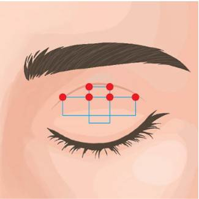 二重埋没法 マルチプルノット