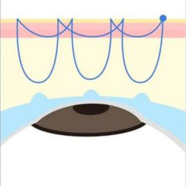 二重埋没法 自然癒着法