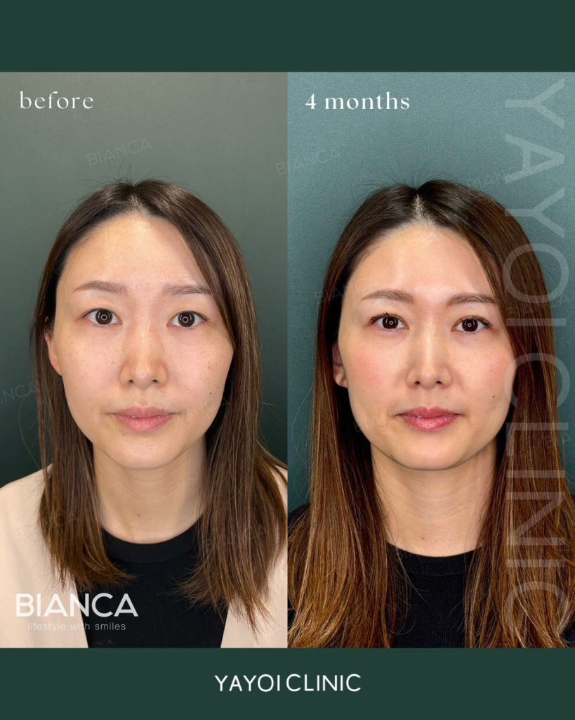 美容外科 二重埋没法(裏留め) B TWICE ➁