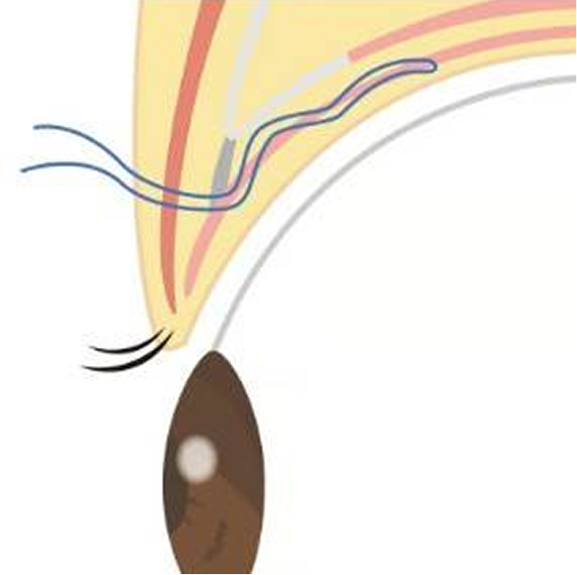 眼瞼下垂（MT法）