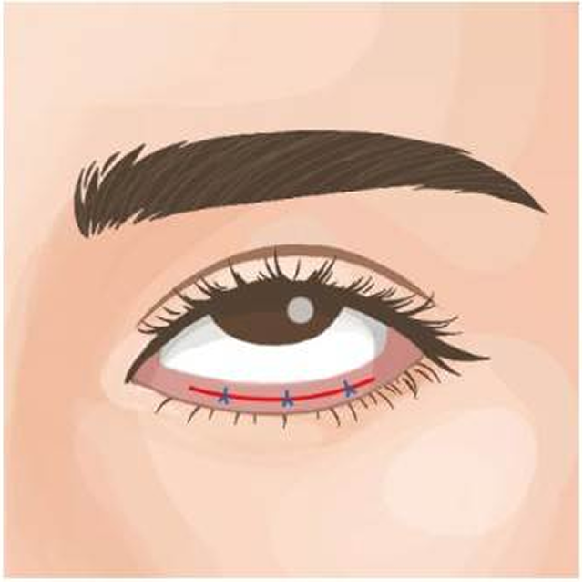 グラマラスライン形成（下瞼開大術）