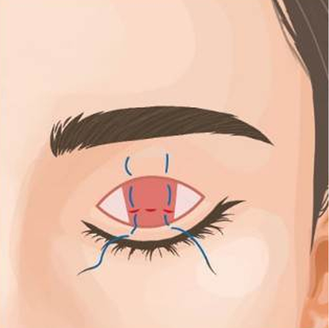 眼瞼下垂切開法