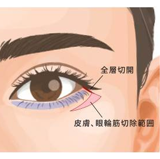 タレ目尻切開（タレ目形成）