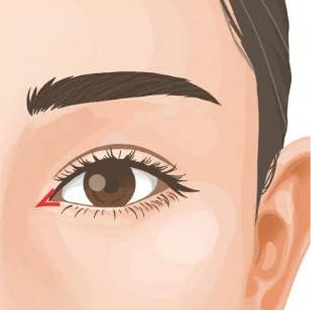 目頭切開
