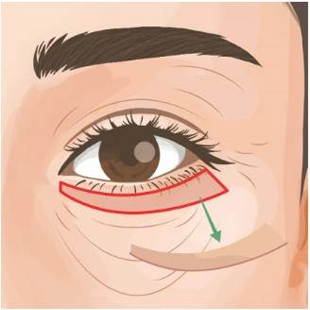 下まぶたたるみ取り