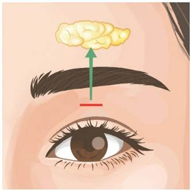 上まぶた脂肪取り