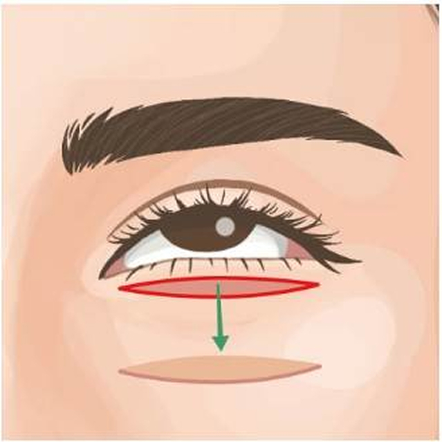 下眼瞼逆さまつ毛修正