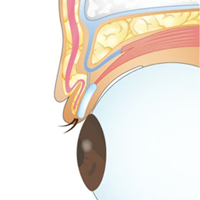 睫毛上皮膚切除（ハム目修正）