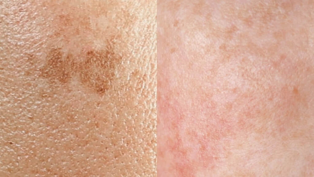 シミ取りを広島で受けたいメンズ必見!ヤヨイクリニックのシミ治療とは?