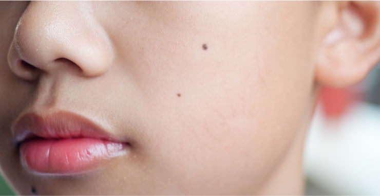 広島のほくろ除去｜皮膚科で受ける前に知っておきたい原因や治療方法