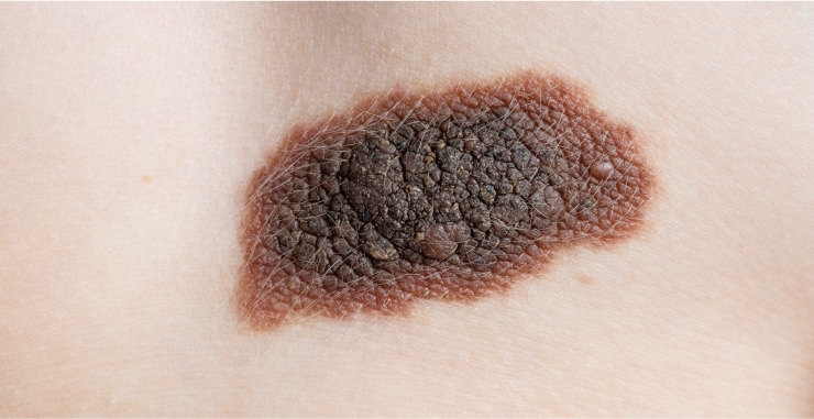 広島のほくろ除去｜皮膚科で受ける前に知っておきたい原因や治療方法