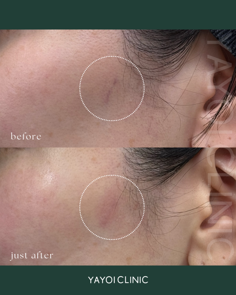 アドバテックス(ドクター施術)