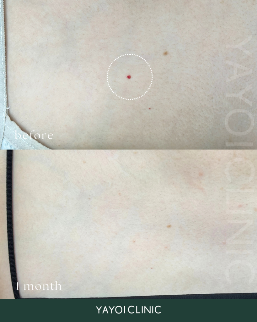 アドバテックス(ドクター施術)