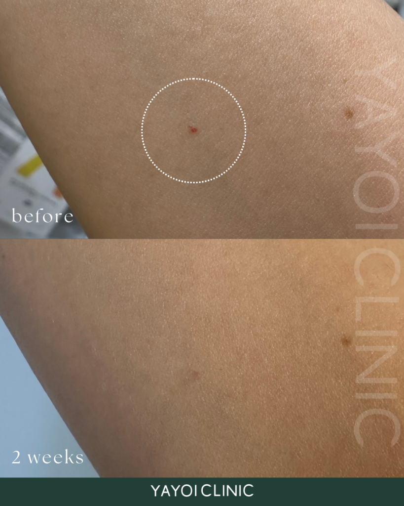 アドバテックス(ドクター施術)