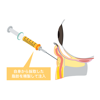 目の下クマ・たるみ取り+コンデンスリッチフェイス（目の下・ゴルゴ）セット