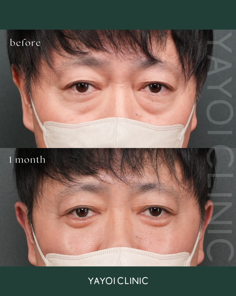 目の下のたるみ・クマ　裏ハムラ法