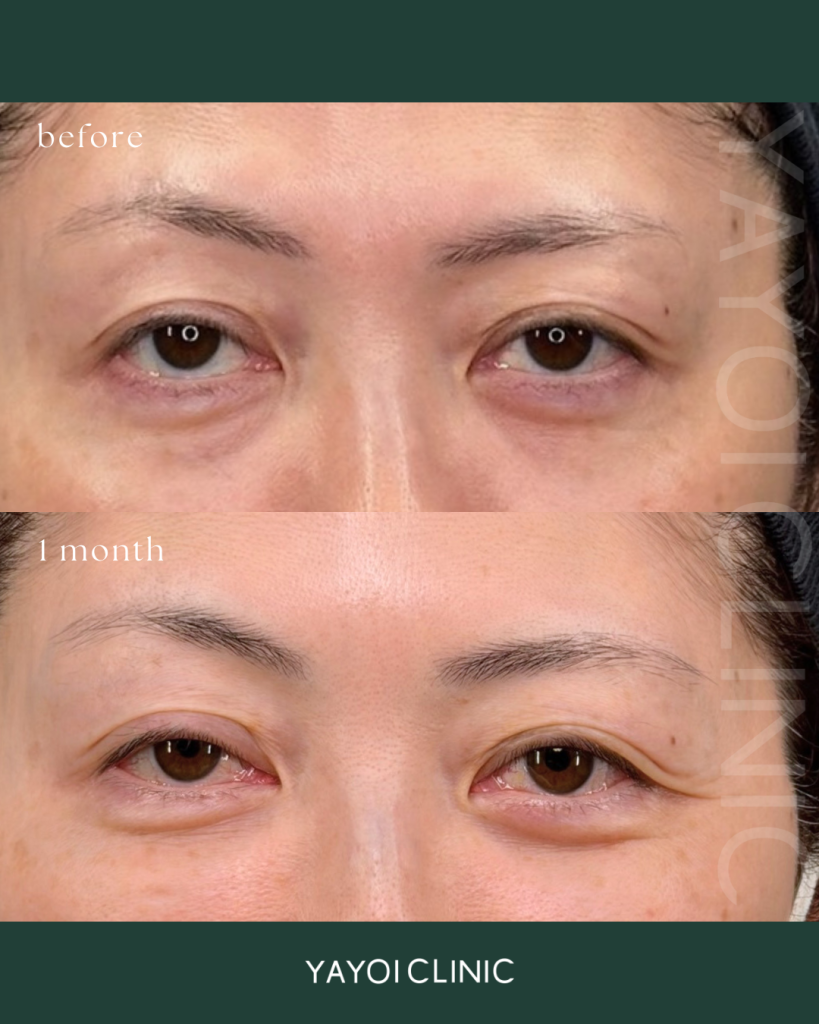 目の下のたるみ・クマ　裏ハムラ法